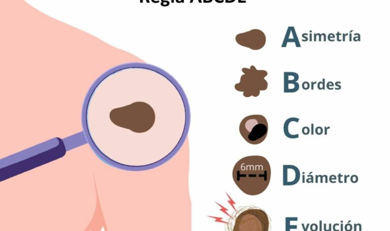 La dermatóloga Irati Allende explica qué es el callo solar y por qué es ...
