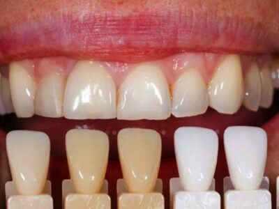 El 40% de la población se acompleja de su sonrisa por no poder blanquearse los dientes