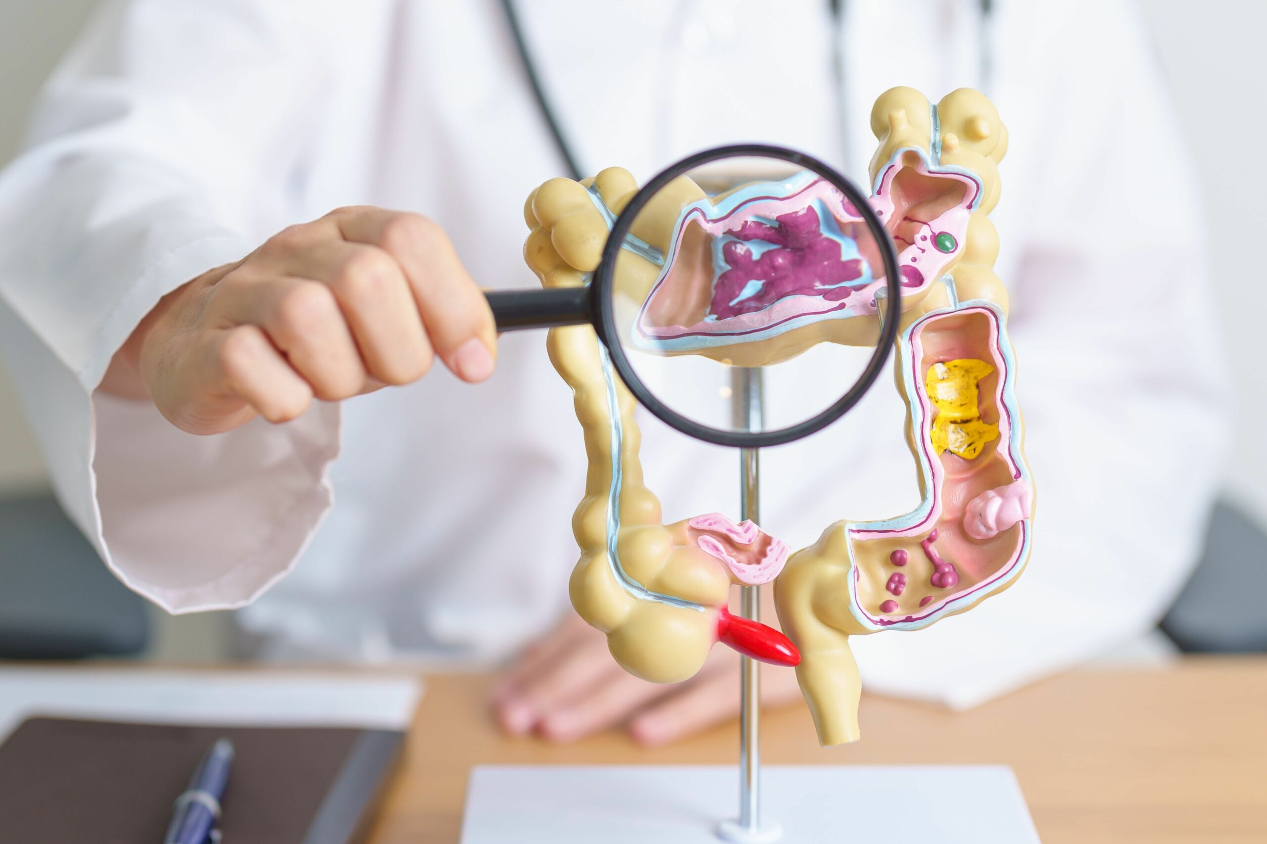 Diverticulitis scaled