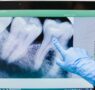 «Cada vez hay más evidencia de que la enfermedad periodontal, una inflamación crónica de las encías, puede estar relacionada con un mayor riesgo de sufrir infartos o accidentes cardiovasculares», doctor Carlos Mederos