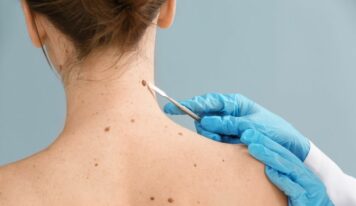 Dra. Ángela Estenaga, dermatóloga de Policlínica Gipuzkoa: «Hay que asumir que algunas pieles no pueden broncearse de forma saludable»