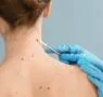 Dra. Ángela Estenaga, dermatóloga de Policlínica Gipuzkoa: «Hay que asumir que algunas pieles no pueden broncearse de forma saludable»