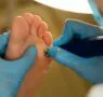 Los podólogos de la Unidad del Pie de Policlínica Gipuzkoa y Podoactiva ofrecen consejos para tratar el aumento de infecciones por hongos en los pies durante el verano