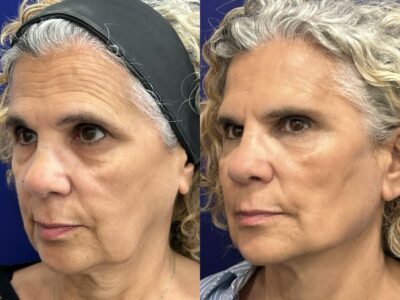 Global Face: nuevo protocolo integral del Dr. Ángel Martín para la recuperación de estructuras faciales, de la firmeza y elasticidad dérmica