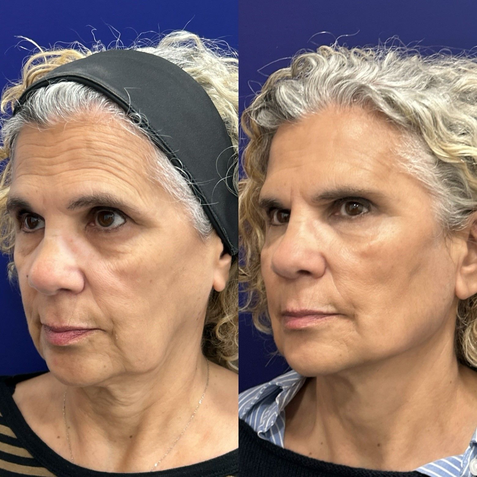 Antesydespus GlobalFace