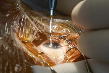 El codirector de FacoElche se somete en directo a la implantación bilateral de una lente diseñada con IA